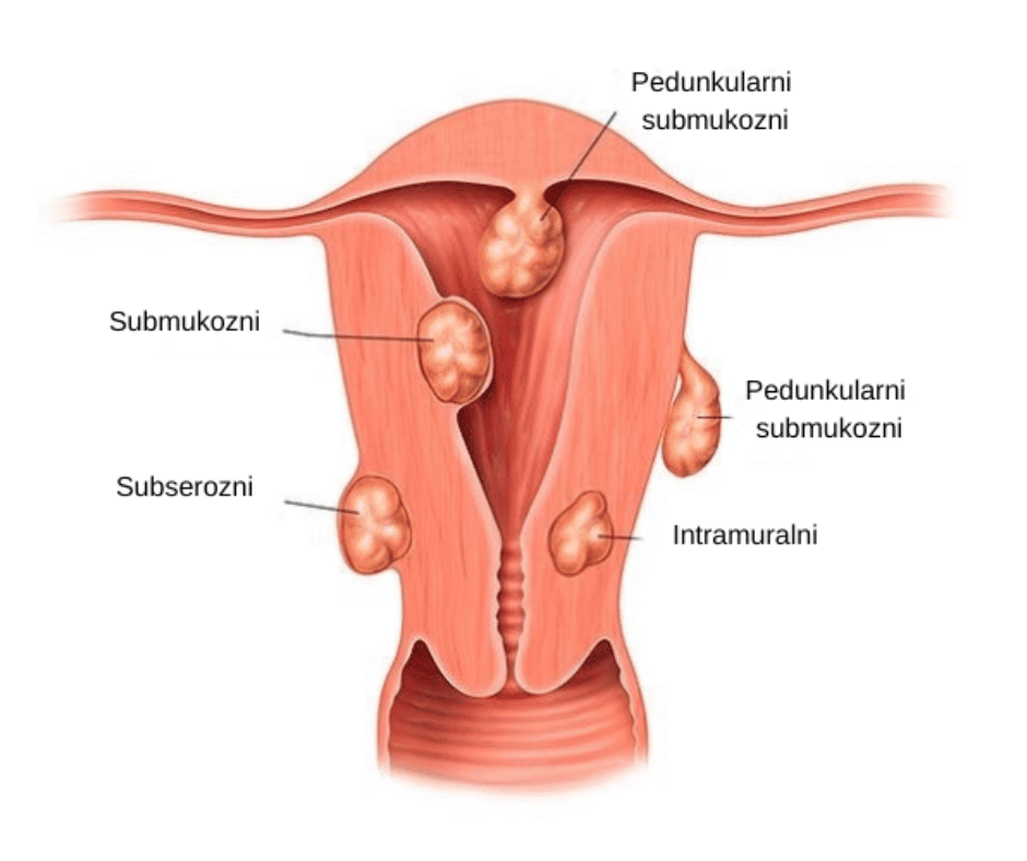 Kako-BabyLab-tablete-za-plodnost-kod-žena-utiču-na-miome-?