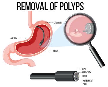 polip
