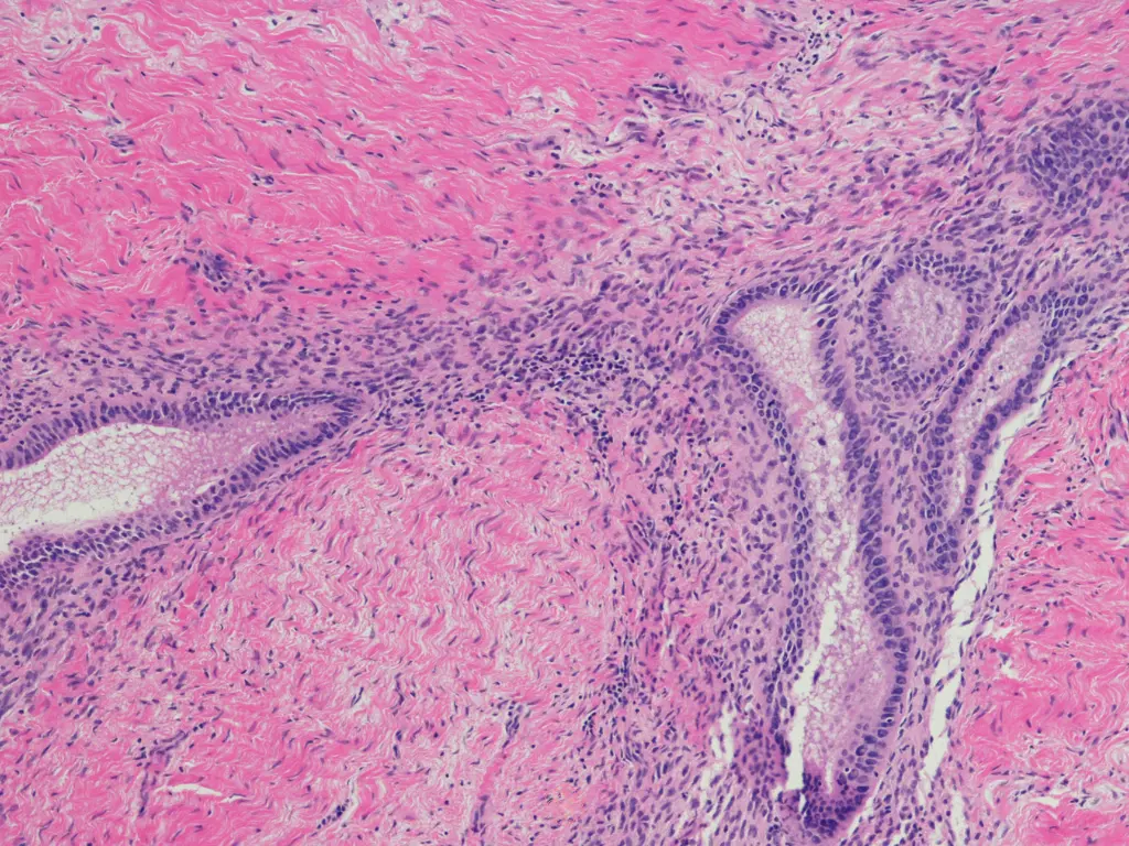 Endometrioza