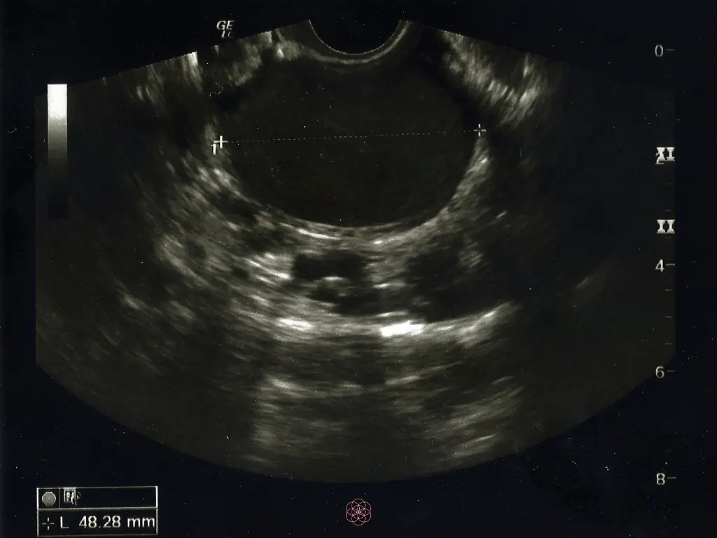 endometrioza ultra zvuk