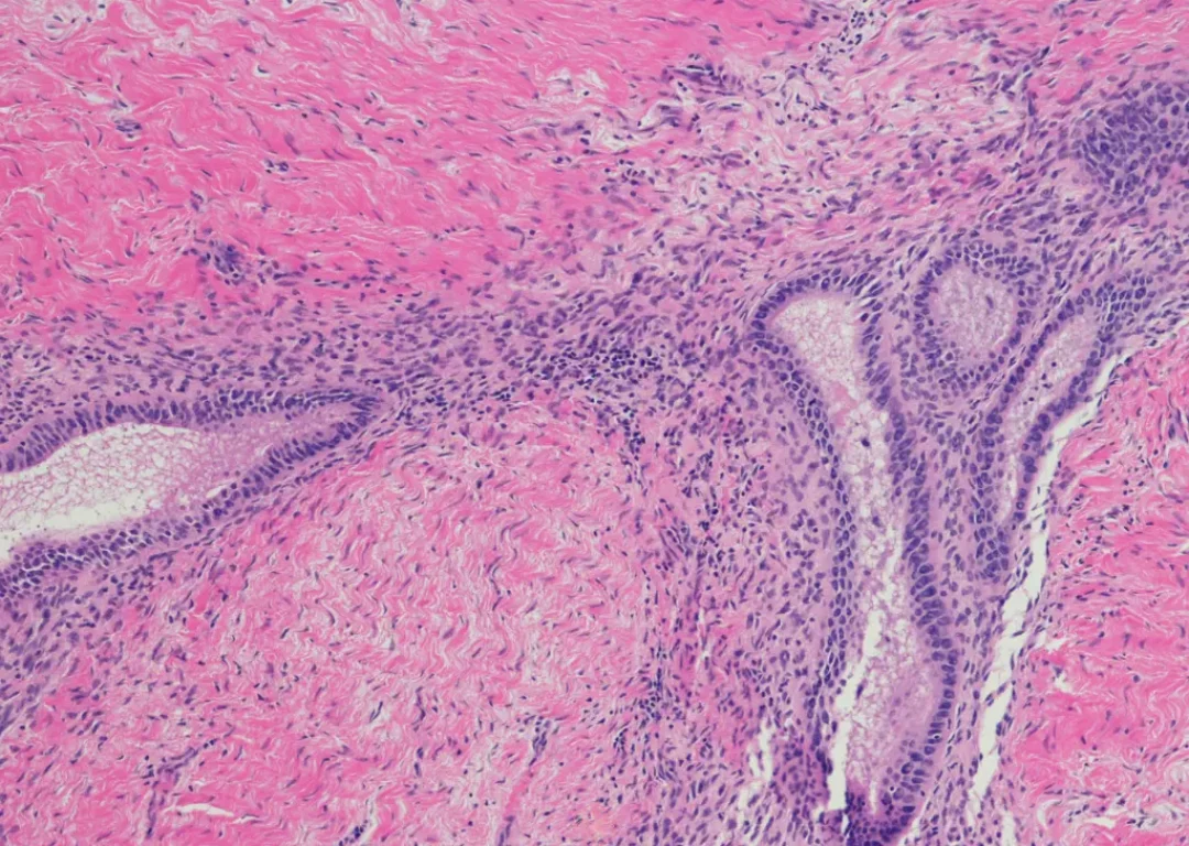 Endometrioza