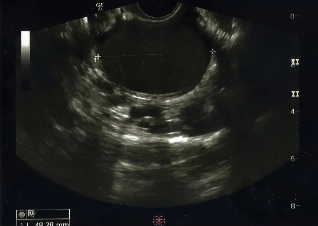 endometrioza ultra zvuk